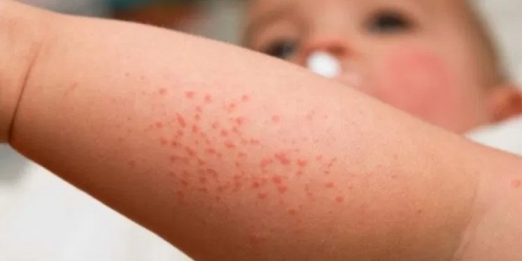 Менингококкт халдварын нөхцөл байдал хүндэрч, долоон тохиолдол бүртгэгдлээ