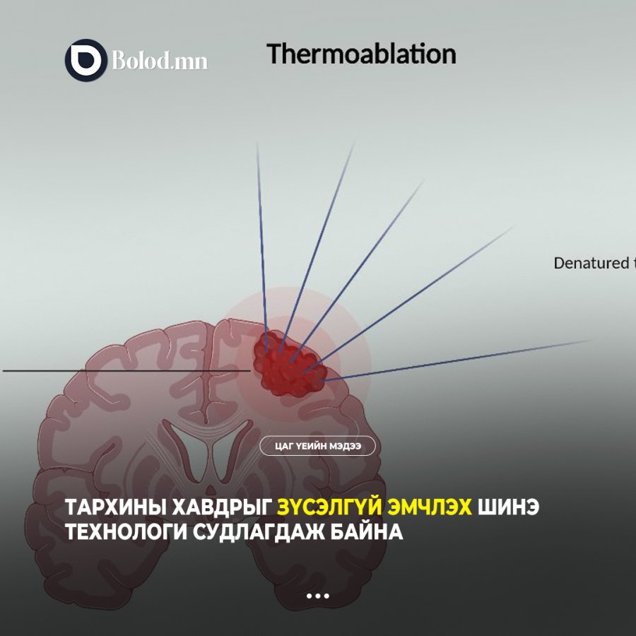 Тархины хавдрыг зүсэлгүй эмчлэх шинэ технологи судлагдаж байна
